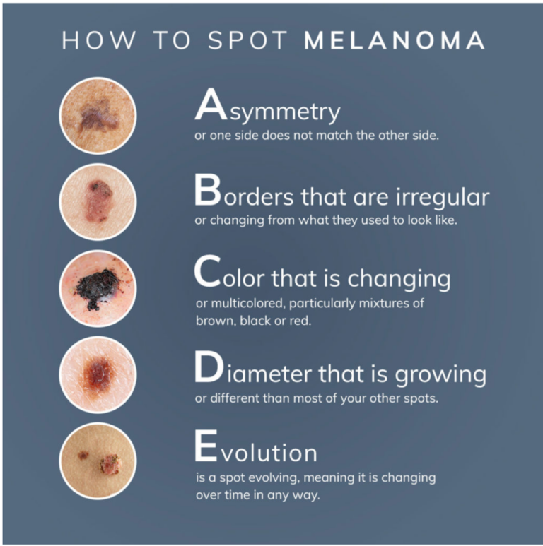 How to spot melanoma nepho